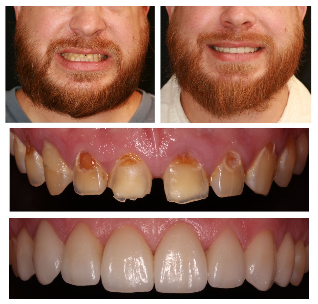 Veneers Douglas Dental Roseville CA